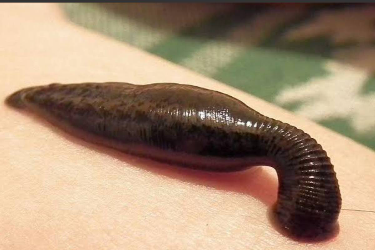 Raktamokshana therapy at home in Hyderabad
